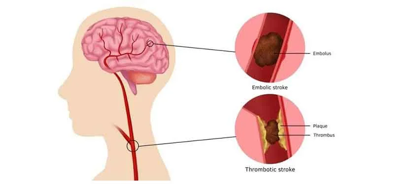 stroke-thrombolysis